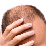 Unique Hair Loss Treatment For Men