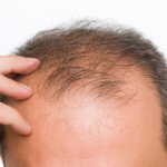 Unique Treatments For Male Pattern Baldness