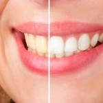 Whiten Your Teeth With A Unique And Simple 75-Minute Procedure 