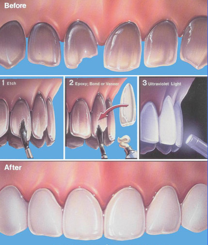 teeth-veneers